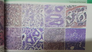 Special Histologic Types of Invasive Breast Carcinoma Part 3  SPECIAL PATHOLOGY [upl. by Eissert]