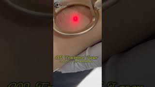 CO2 Fractional Laser Treatment laserengraver skincare skinrejuvenation wrinkleremoval [upl. by Gorden182]