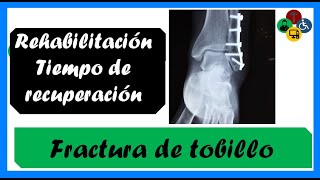 Fractura de TOBILLO  Fractura de TIBIA Y PERONÉ Tiempo de recuperación [upl. by Elery764]