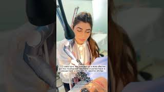 Fractional CO2 Laser for acne scars SuggarDaddy98 [upl. by Xila]