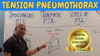 Tension pneumothorax  Causes Clinical Correlations  Emergency Treatment🩺 [upl. by Fe]