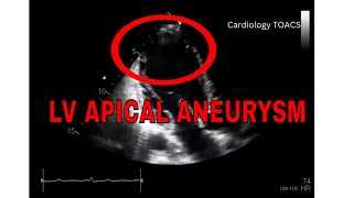 Left Ventricular Apical Aneurysm  ECHO [upl. by Nedi]