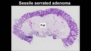 Serrated polyps Learn to tell the difference between hyperplastic polyp and sessile serrated lesion [upl. by Luce669]