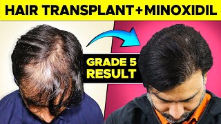 FUE Hair Transplant 3000 Grafts Norwood Grade 5 by Saraswat Hospital Hair Transplant Agra India [upl. by Sedaiuqlem999]