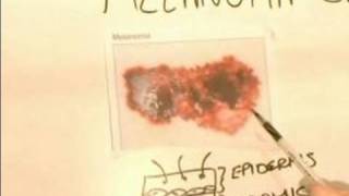 How to Identify Skin Cancer  Signs of Melanoma Carcinoma Skin Cancer [upl. by Hodosh]