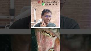 Dr Rudra Mohan Oral Sub Mucous FibrosisOSMFdrrudrasdentalcare drrudramohan osmf osmftreatment [upl. by Vandyke]