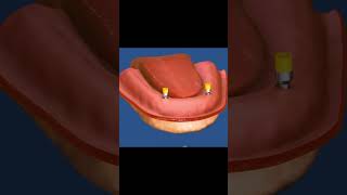 How do snap in dentures work [upl. by Beutner]