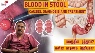 Blood in stool – Causes diagnosis and treatment [upl. by Sonny]