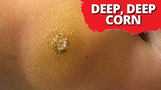 DEEPSeated Corn Removal On Dancer MUST WATCH [upl. by Malva]