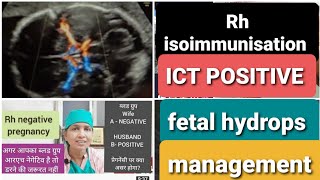 RH negative प्रेगनेंसी में ICT पॉजिटिव है ।अब क्या करें RH Isoimmunization amp fetal hydrops [upl. by Harshman]