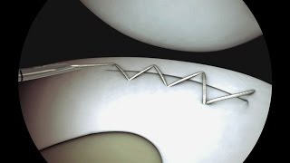 Sequential Meniscal Running Stitch Using Sequent®  CONMED Animation [upl. by Ecyned41]