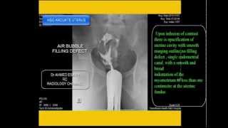 CASE 98 ARCUATE UTERUS [upl. by Pena510]