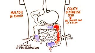 Maladie Inflammatoire de Lintestin MII [upl. by Nylcoj]