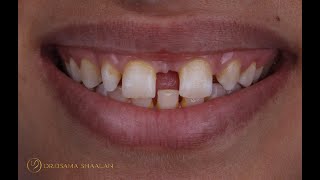 Combined approach for large diastema closure part II [upl. by Ttcos868]