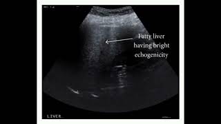 Fatty liver on ultrasoundRadiology Vibes [upl. by Fabi]