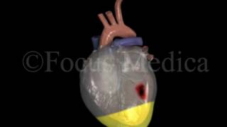 Pericardial effusion  Heart [upl. by Ettenwad]