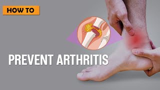 Arthritis Of The Fingers  Everything You Need To Know  Dr Nabil Ebraheim [upl. by Auohs]