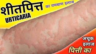 शीतपित्त पित्ती का अचूक इलाज   Urticaria Treatment  Dr Madhusudan [upl. by Nonnarb]