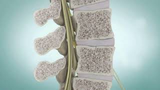 Spinal Stenosis and Spine Surgery  Medical Animation [upl. by Orimar]