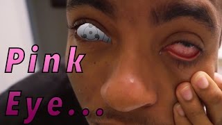 Pink Eye Conjunctivitis Apple Cider Vinegar Home Remedy [upl. by Tanhya]