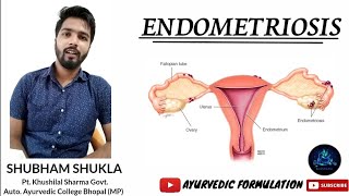 ENDOMETRIOSISDefinition Etiologic FactorsPathogenesis Clinical FeaturesDiagnosis amp Treatment [upl. by Emeric]