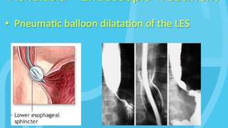 Treatment of Achalasia [upl. by Jonathon]