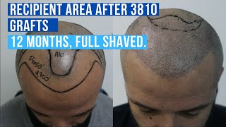 Hair Transplant Turkey 3810 Grafts No DHI Hair Transplant 2020 [upl. by Eileme]