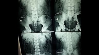 IVPIVU Intravenous UrographyPyelography BASICS OF RADIOGRAPH EXPLAINED [upl. by Ynatterb468]