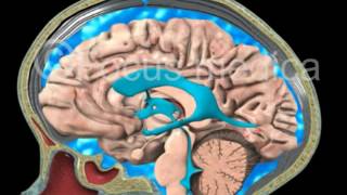 CSF leakage  Neuroanatomy [upl. by Iralav]