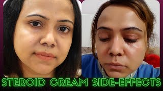 Treatment of Steroid Cream Side Effects and How To Bring back you original Skin Tone [upl. by Rhonda]