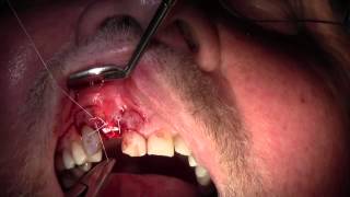 Extraction 7 amp Repair of Dehiscence Defect Suturing Technique [upl. by Schnell918]