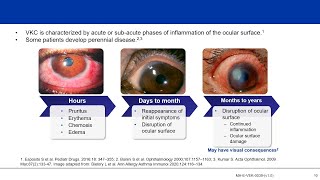 Understanding Vernal Keratoconjunctivitis VKC Not “Just an Allergy” [upl. by Matthaeus565]