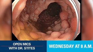 Open Mics with Dr Stites  Familial Adenomatous Polyposis [upl. by Brandwein]