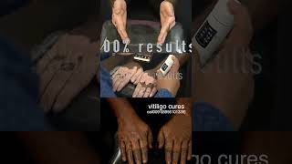 FIX 100 VITILIGO WITH PIGMENTOZ  VITILIGO PERMANENT TREATMENT WHITE SPOT CURE vitiligocures [upl. by Barnabe482]