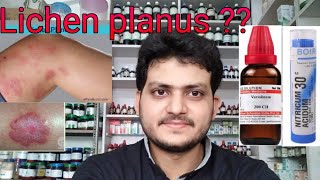 Lichen planus Homeopathic medicine for lichen planus explain [upl. by Leirad]