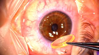 Corneal Transplant Penetrating Keratoplasty for Advanced Keratoconus and Corneal Infiltrates [upl. by Hajidak]