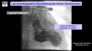 Hypertrophe Kardiomyopathie HOCM  Laevokardiographie [upl. by Adnoval]