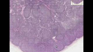 Histopathology Lymph node  Follicular hyperplasia [upl. by Arayt125]