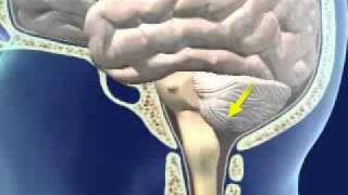 Brainstem Herniation [upl. by Sheepshanks]