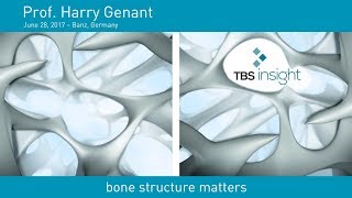 Prof Dr Harry Genant about TBS [upl. by Etteoj]