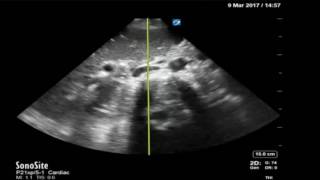 Using Bedside US to Differentiate Shock IVC JETem 2017 [upl. by Lehteb287]