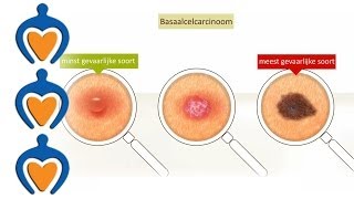 Huidkanker  Basaalcelcarcinoom video 2 van 5 [upl. by Arzed]