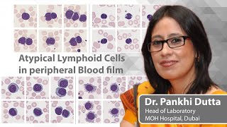 Commonly seen and not so commonly seen Atypical Lymphoid in the peripheral blood  Dr Pankhi Dutta [upl. by Nilatak]