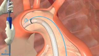 Thoracic Endovascular Aortic Aneurysm Repair in Dallas [upl. by Pedersen]