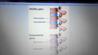 Spondylosis Arthritis of the Spine [upl. by Attoynek]