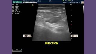 Ultrasound Guided Popliteal Sciatic Nerve Block and sonoanatomy of the popliteal fossa [upl. by Yerrot]