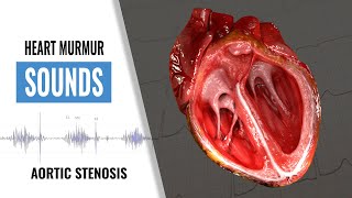 Aortic Stenosis Heart Sound  Heart Murmur  Christina NP [upl. by Nirrok]