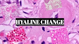 HYALINE CHANGE  FUNDAMENTALS WITH EXAMPLES [upl. by Sibyl]