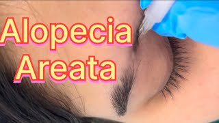 Alopecia Areata skin dermatologist skintreatment skincare ytshorts ytshortsvideo alopecia [upl. by Eromle333]