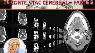 TAC cerebral corte 7 parte 2 [upl. by Osgood]